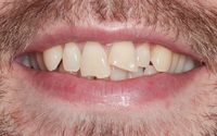 Adult Braces & Bonding before